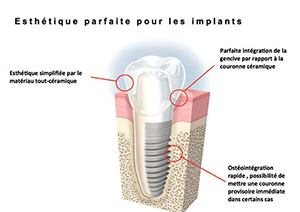 Chirurgie pré-implantaire à Salon de Provence