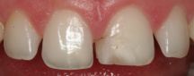 Cas Cliniques - Esthétique dentaire